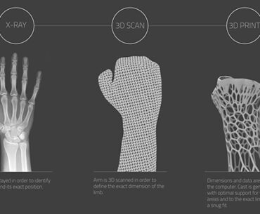Overhauling the Cast System: A 3D-printed Panacea for Your Next Busted Bone