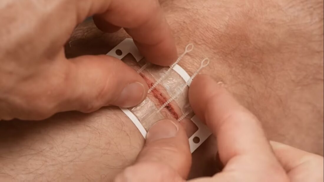 ZipStitch