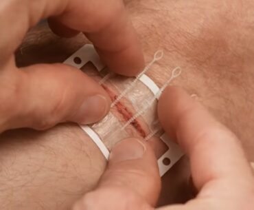 ZipStitch Redesigns the Zip Tie for On-The-Spot Laceration Treatment ZipStitch